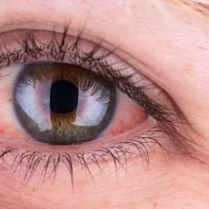 A vörös szemek oka egy felnőttnél és a kezelési módszereknél. Sérülések és szembetegségek